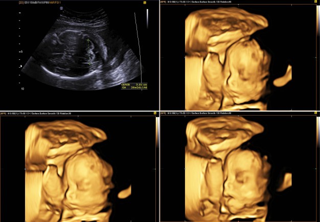 Controlli in gravidanza: l’ecografia 3D-4D