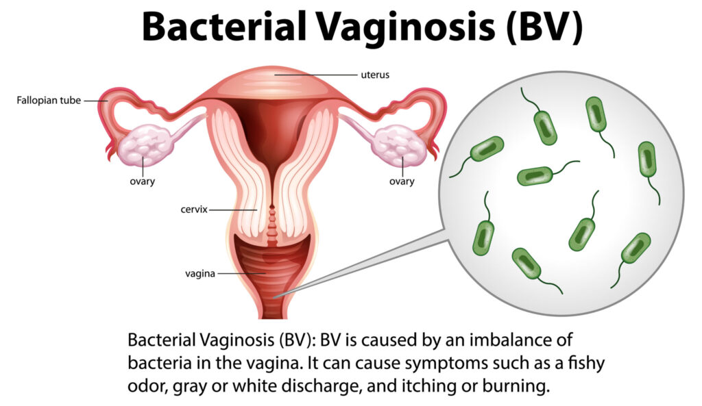 Il vaginismo: sintomi e terapie